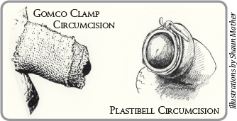 Circumcised Penis - Illustrations by Shaun Mather