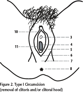 Type I Circumcision (removal of clitoris and/or clitoral hood)