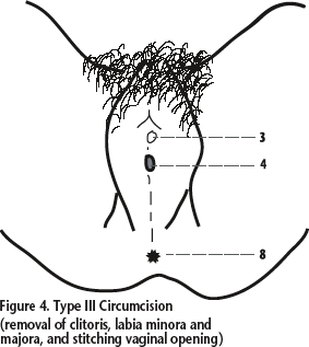 Type II Circumcision (removal of clitoris and labia minora and majora)